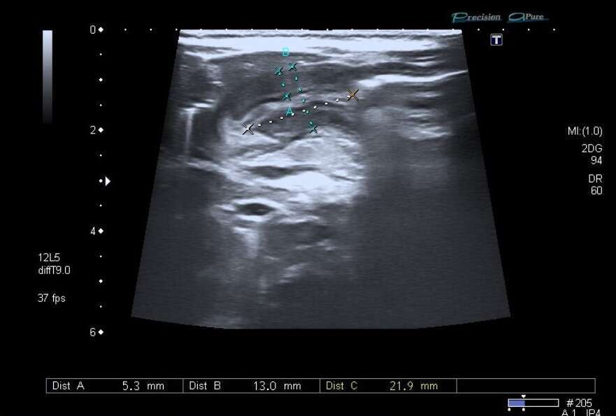 Abdominal ultrasound: Pyloric channel with diagnostic criteria for HPS.